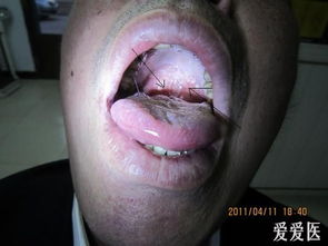難治的口腔粘膜白斑是何物